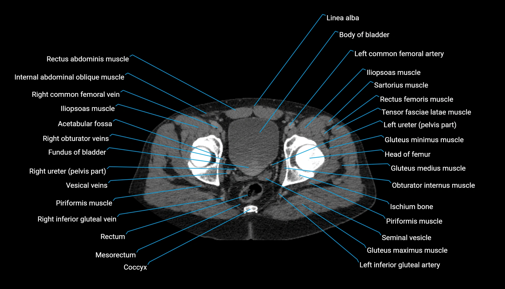 CT urogram axial cross sectional anatomy  labelled radiology image-00227.webp